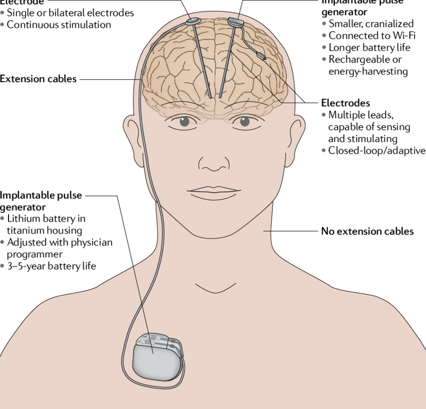 Image showing the location of battery placement in DBS patients