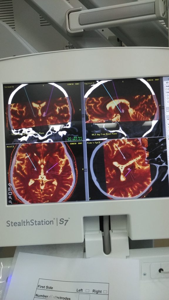 Planning process on the Stealth station for Deep brain stimulation (DBS) surgery