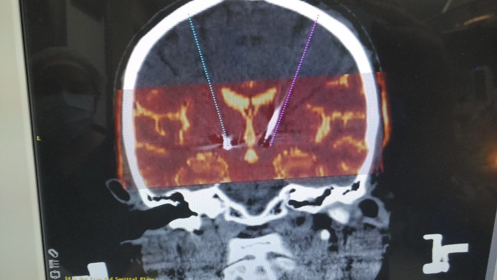 Check CT brain re-merged with the software to cross check the electrode trajectories