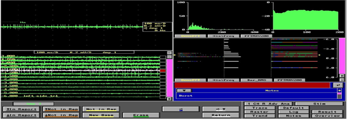 Microelectrode recording of subthalamic nucleus during Deep brain stimulation (DBS) surgery